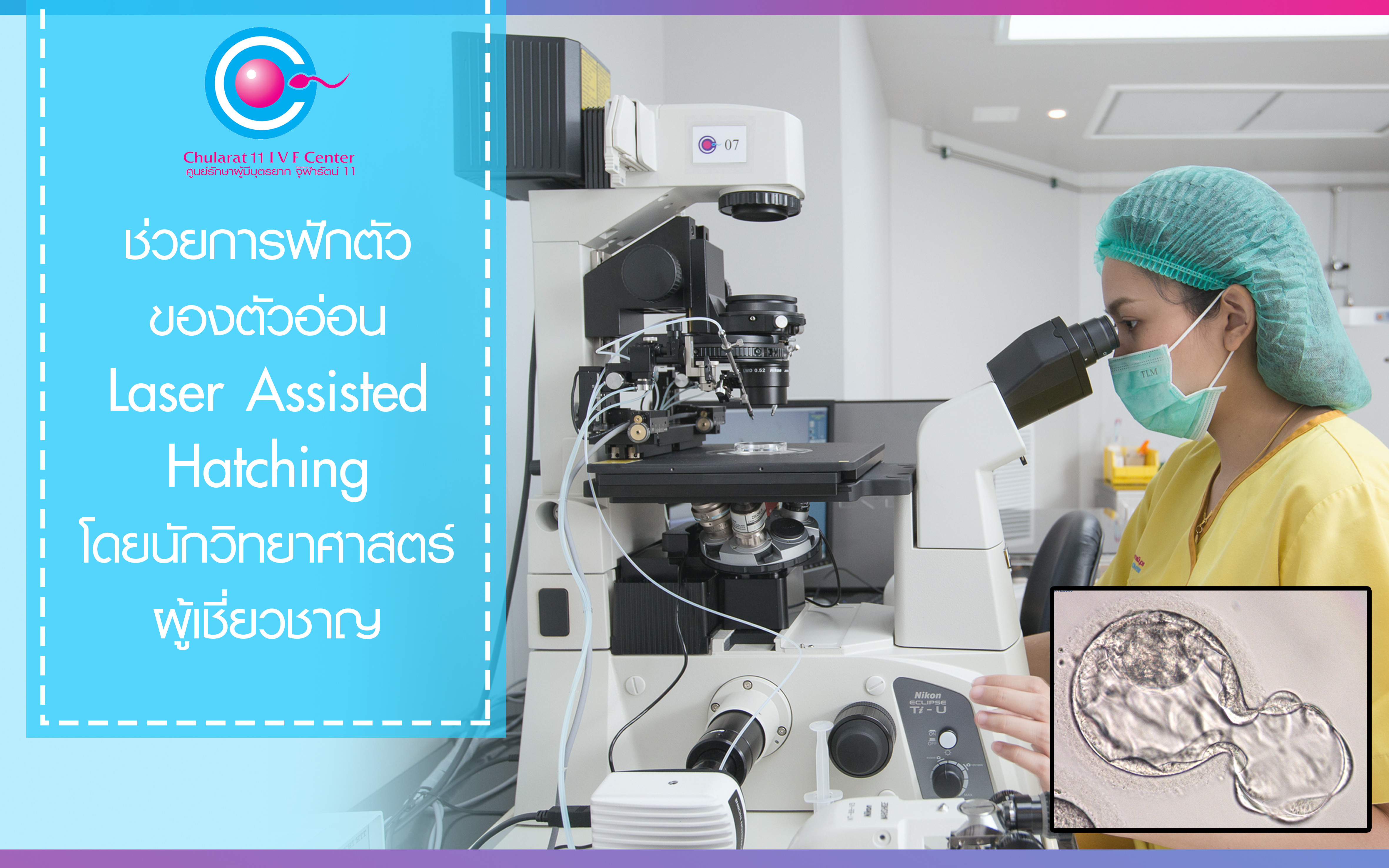 เทคโนโลยีช่วยการฟักตัวของตัวอ่อน ( Laser Assisted hatching ) - ศูนย์รักษาผู้มีบุตรยาก โรงพยาบาลจุฬารัตน์ 11 อินเตอร์